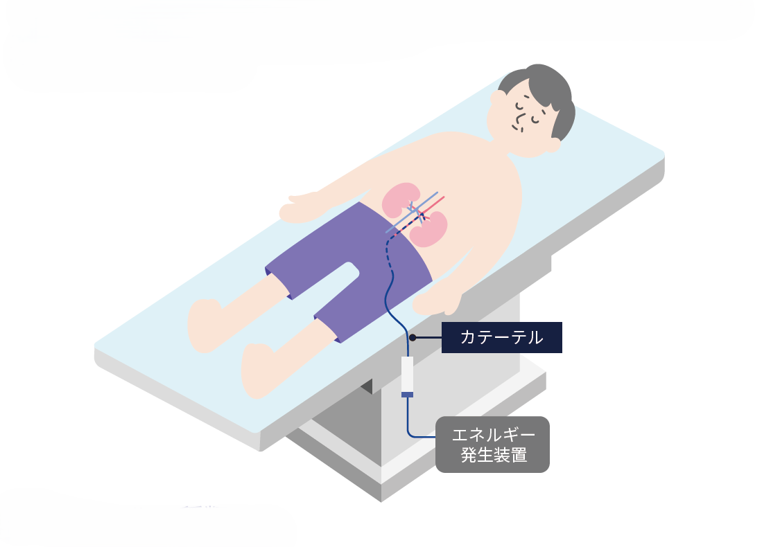 腎デナベーション治療のイメージ